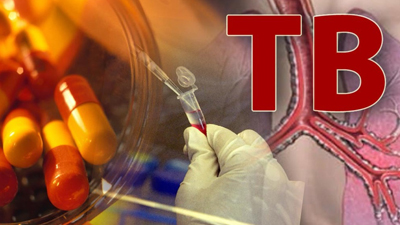 TB is currently the number one killer among infectious diseases in the world.