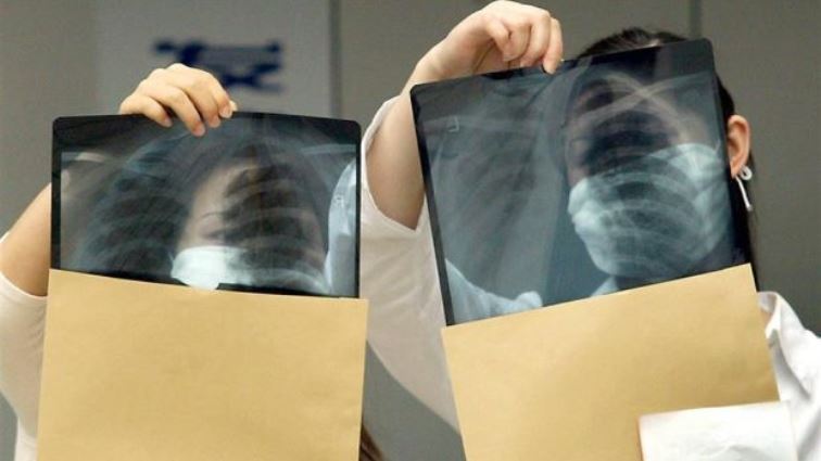 Tuberculosis killed at least 1.7 million people in 2017, according to the World Health Organization.
