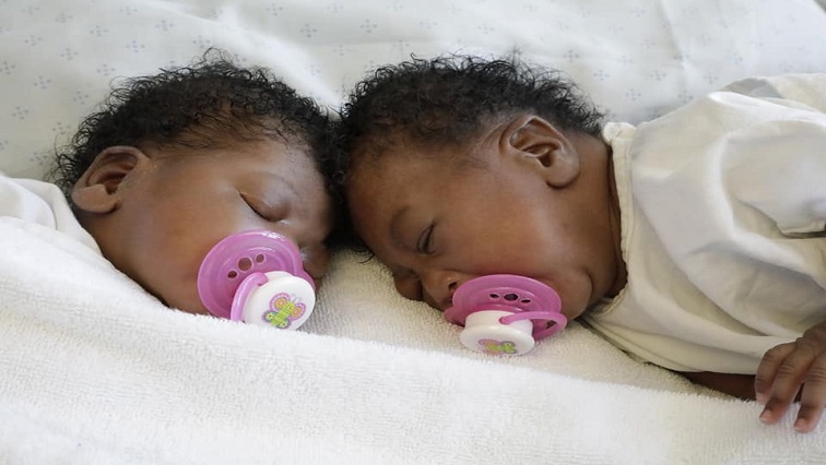 The Head of pediatric neurosurgery at the hospital, Professor Tony Figaji says the babies were joined at the head in the rarest form of conjoined twinning.