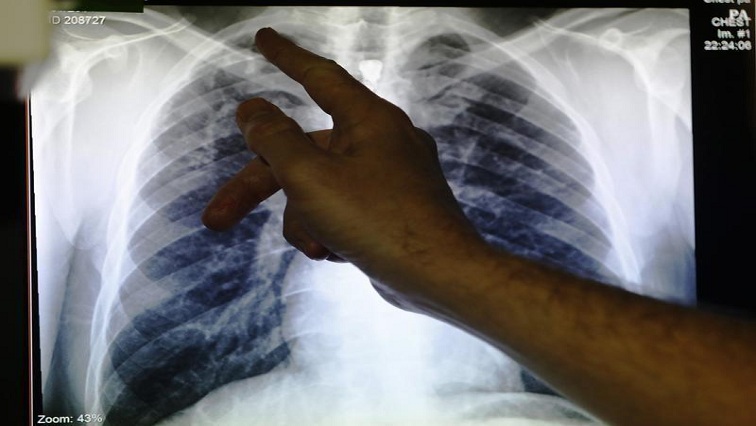 The Fund's annual report for 2020, released on Wednesday, showed that the number of people treated for drug-resistant tuberculosis in countries where it operates fell by 19%.