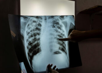 An infectious disease specialist intern, analyses an X-ray of 24-year-old patient, who is currently undergoing treatment for tuberculosis... [File image]