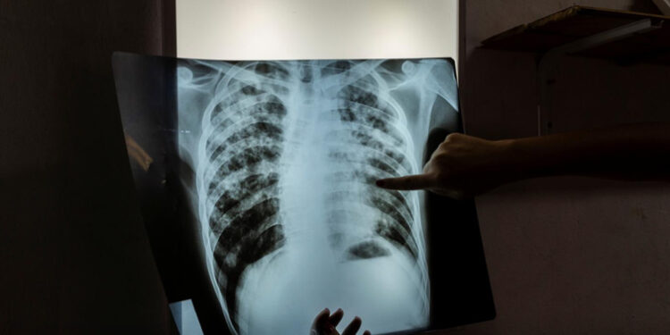 An infectious disease specialist intern, analyses an X-ray of 24-year-old patient, who is currently undergoing treatment for tuberculosis... [File image]