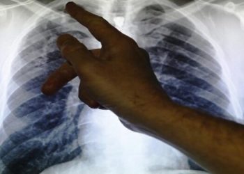 Clinical lead Doctor Al Story points to an x-ray showing a pair of lungs infected with TB (tuberculosis)