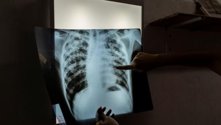File image: An infectious disease specialist intern analyses an X-ray of a patient who is  undergoing treatment for tuberculosis.